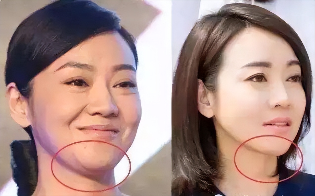 千万别做拉皮手术后遗症太可怕了,拉皮手术会有什么后遗症吗