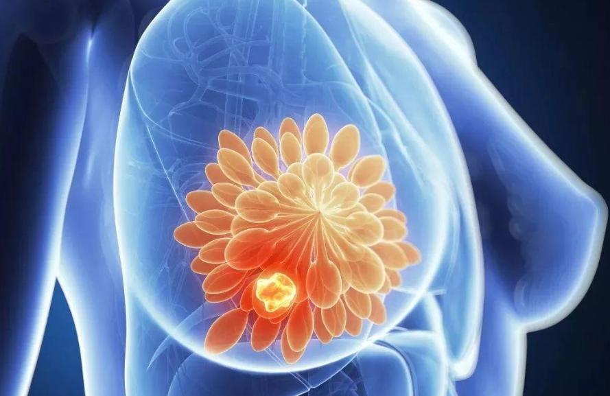 保乳术后的放射治疗