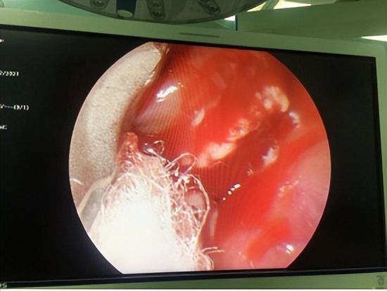 鱼刺卡喉求医6次,记录求医之路