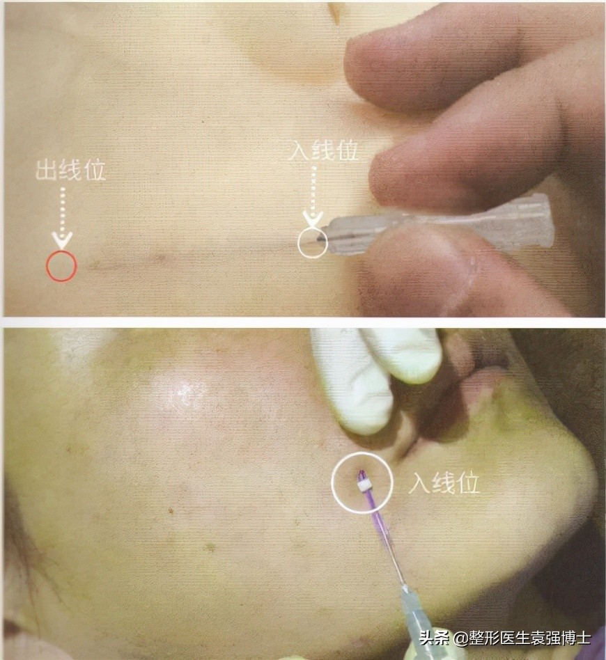 做完线雕不戴头套感觉撕拉痛,做完线雕为什么不能嚼硬东西