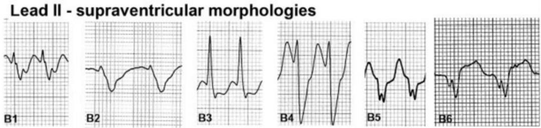 心电图上表现为宽qrs波,心电图中qrs是代表心动过速吗