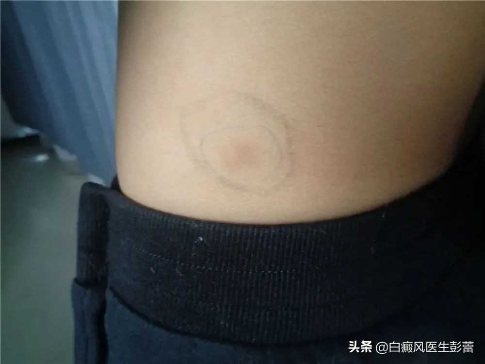 白癜风治愈后复发的可能性大吗,为什么白癜风会在原有位置复发