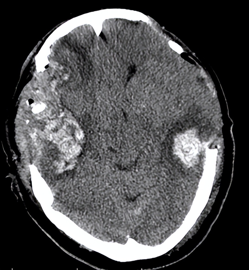 医院成功救治重型颅脑患者,特重型颅脑损伤治愈案
