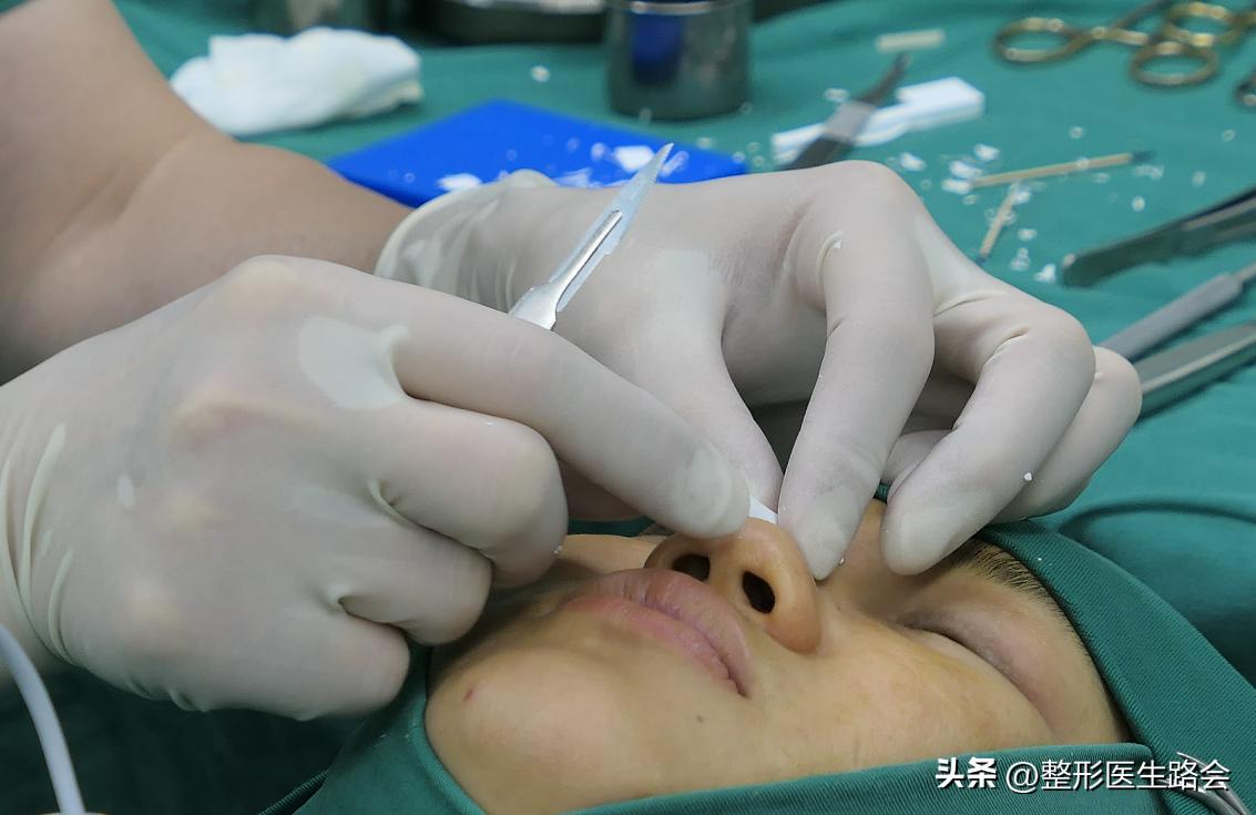 膨体隆鼻感染的概率高吗,膨体隆鼻感染契机