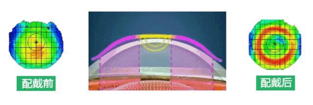 角膜塑形镜控制度数的原理是什么,角膜塑形镜控制近视度数增长
