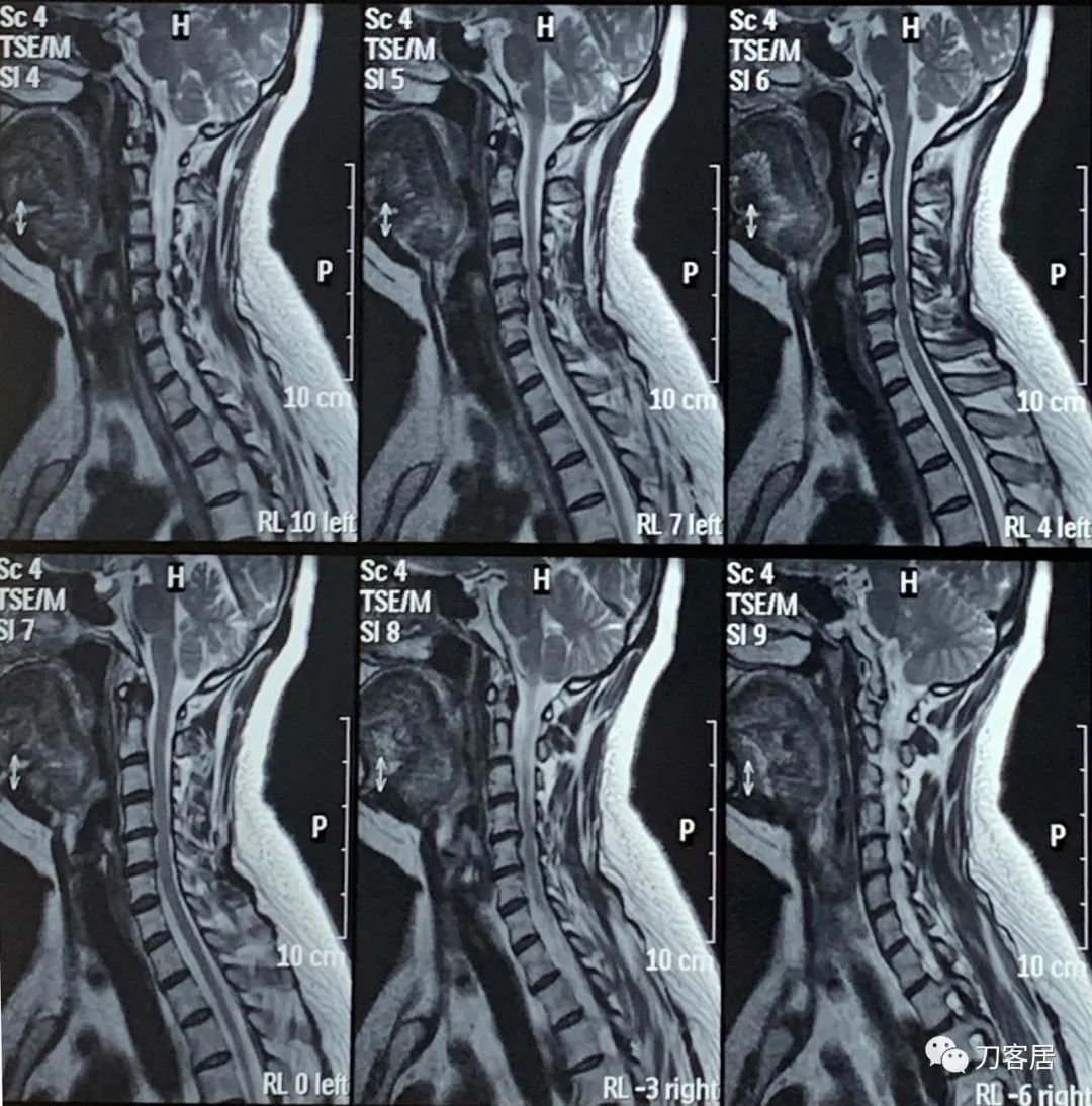 颈椎病十年了手臂酸痛肩背痛,颈椎病十年了一直痛怎么办