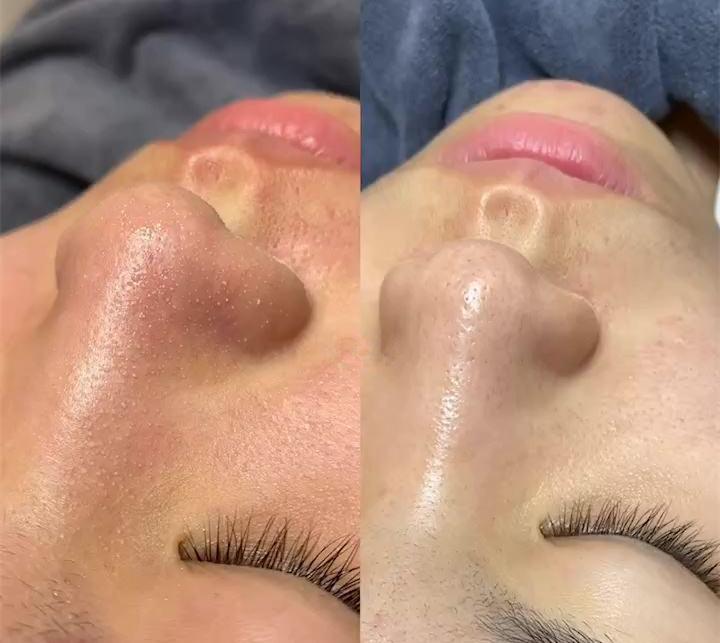 鼻子上好多黑头把毛孔堵住了,鼻子上的黑头怎么去除最有效方法