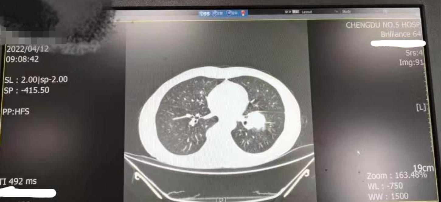 抽烟一次确诊4种癌,吸烟30年夫妻同时检查出肺癌