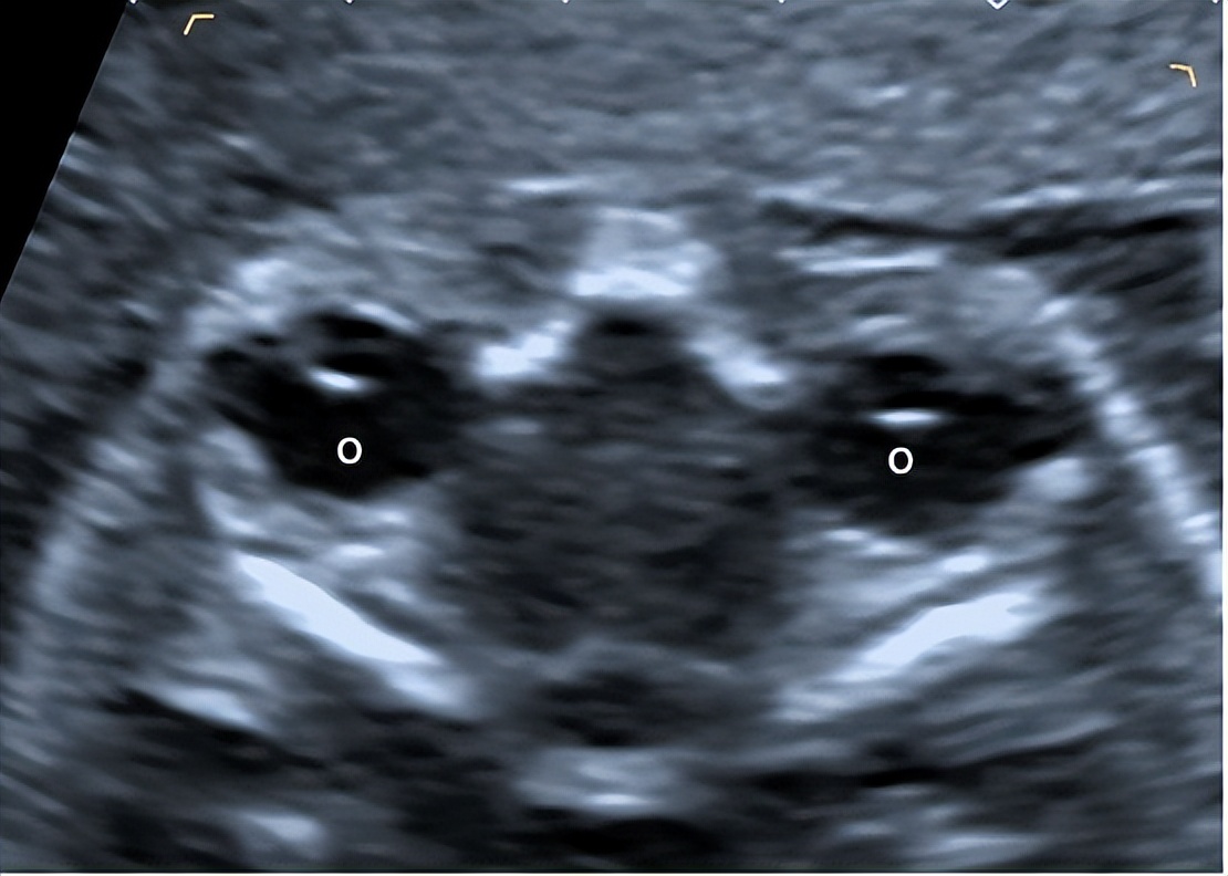 2022年产前超声筛查指南,胎儿超声异常的产前诊断
