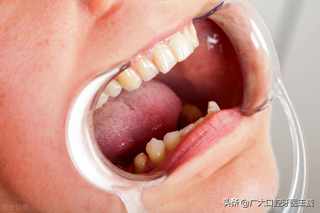 牙龈肿胀发炎疼痛吃什么药,牙龈发炎疼痛是怎么回事