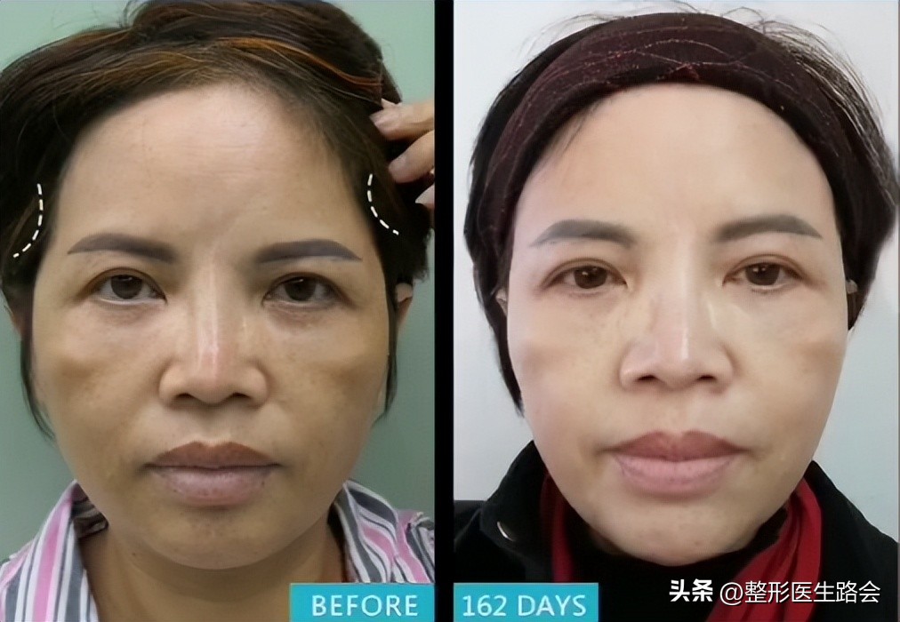 上海九院膨体填充太阳穴费用多少,膨体丰太阳穴视频全过程