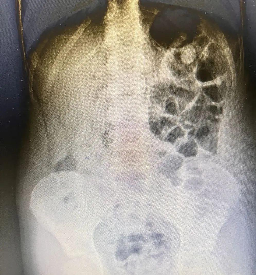 小女孩大便困难怎么办,小女孩大便干拉不出来怎么办