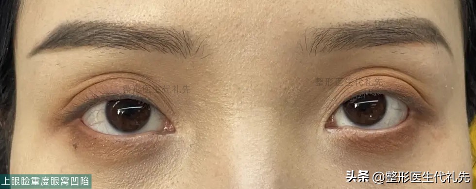 眼窝凹陷睡觉可以恢复吗,长时间熬夜下眼窝凹陷可以恢复吗