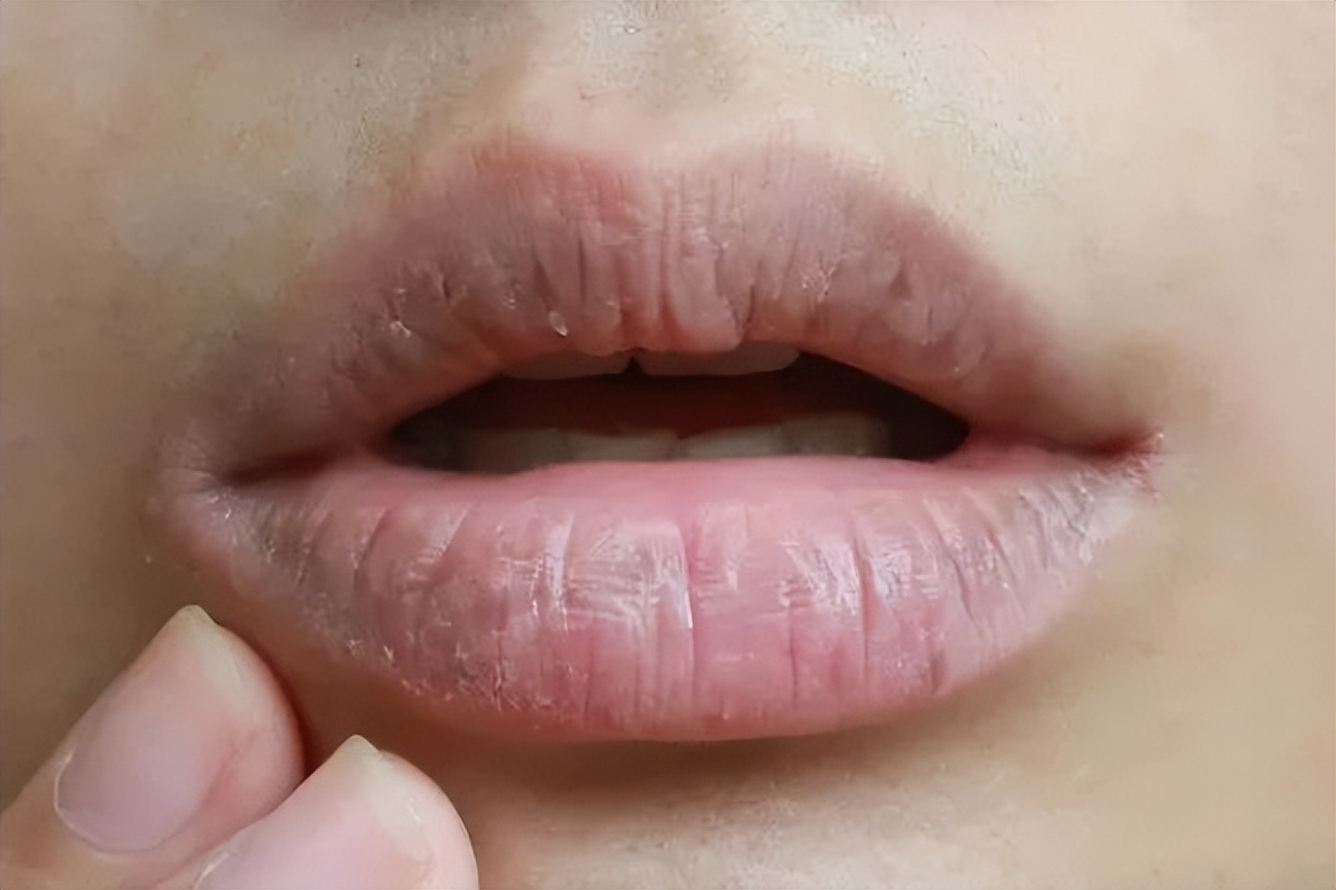 宝宝的嘴巴干的起皮怎么办,宝宝嘴唇干燥起皮用什么唇膏