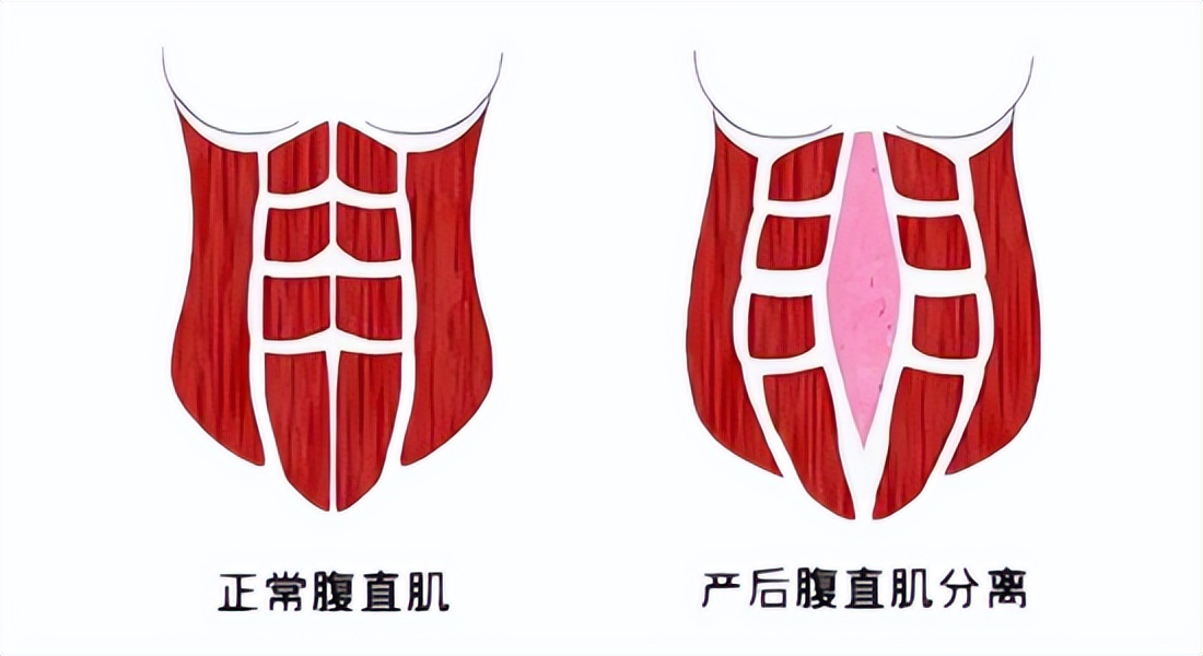 产后修复小蛮腰,9个动作还你产后小蛮腰