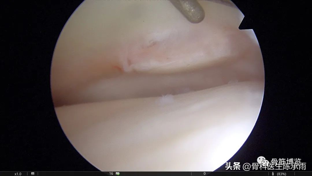 1-2度半月板后角损伤,半月板后角损伤手术解决方案
