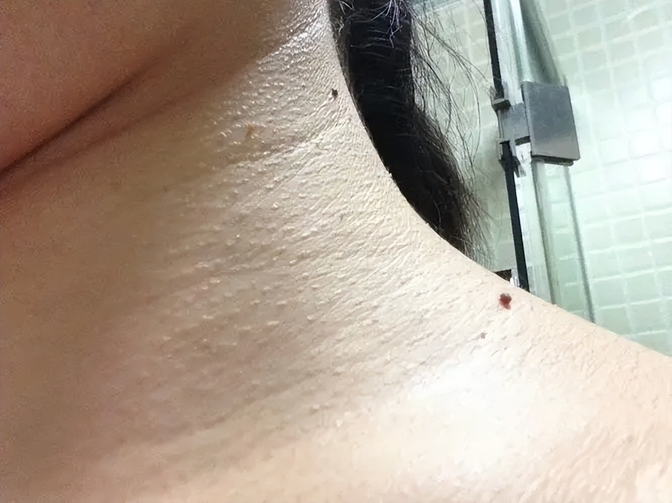 脖子和腋下的小肉粒是什么,脖子和腋下长小肉刺会自己脱落吗