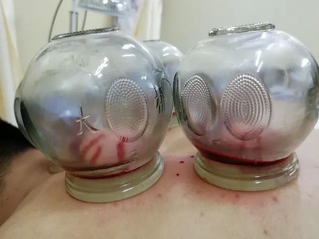 带状疱疹后遗神经痛针灸治疗方法,舒卿针灸治疗带状疱疹后遗神经痛