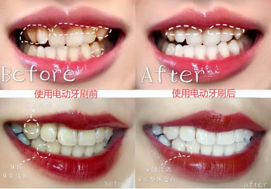 电动牙刷伤牙吗？个护博主揭秘三大隐患