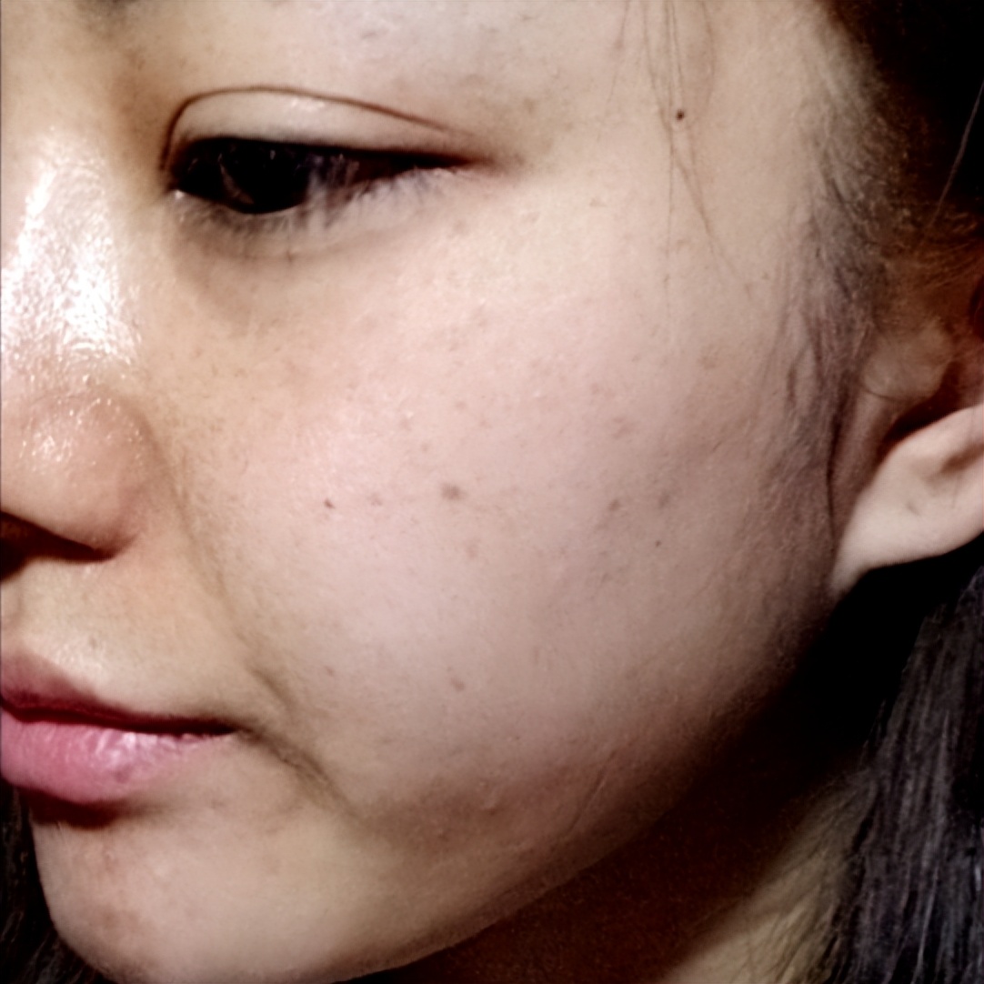 祛斑做手术靠谱吗,激光祛斑和中药提取祛斑哪个好