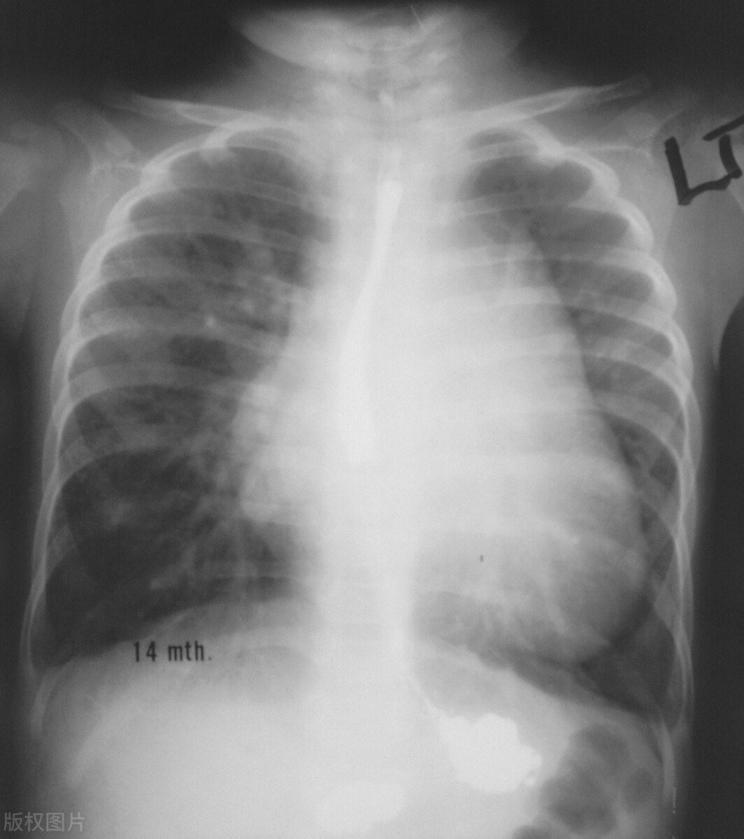 肺心病是怎么得的呢,肺心病反复发作你知道为什么吗