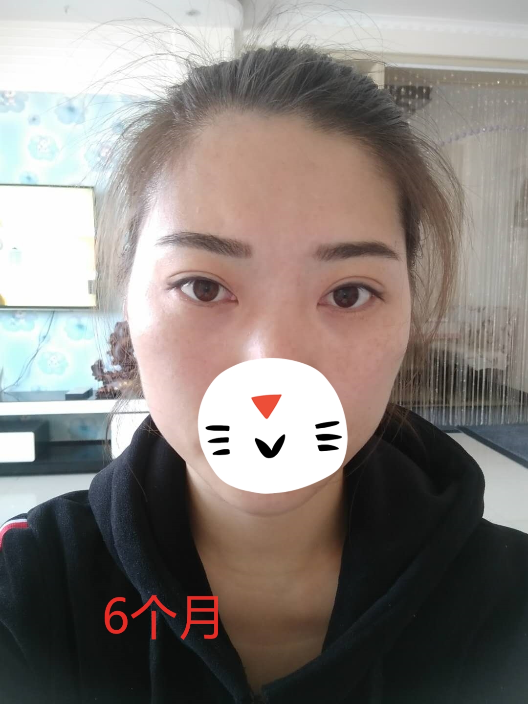 新乡修复双眼皮,河南女子双眼皮修复出现洞