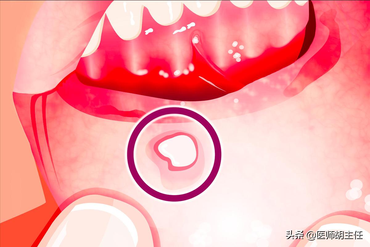 口腔溃疡用什么维生素来医治,口腔溃疡吃什么维生素治好得最快