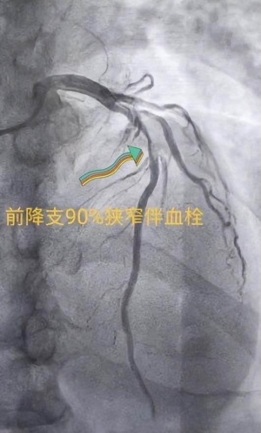 西安市红会医院：肚子疼痛多日检查后竟是心梗医生：警惕无痛性心肌梗死