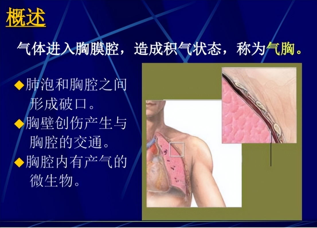 空气中的气体科普,空气栓塞科普