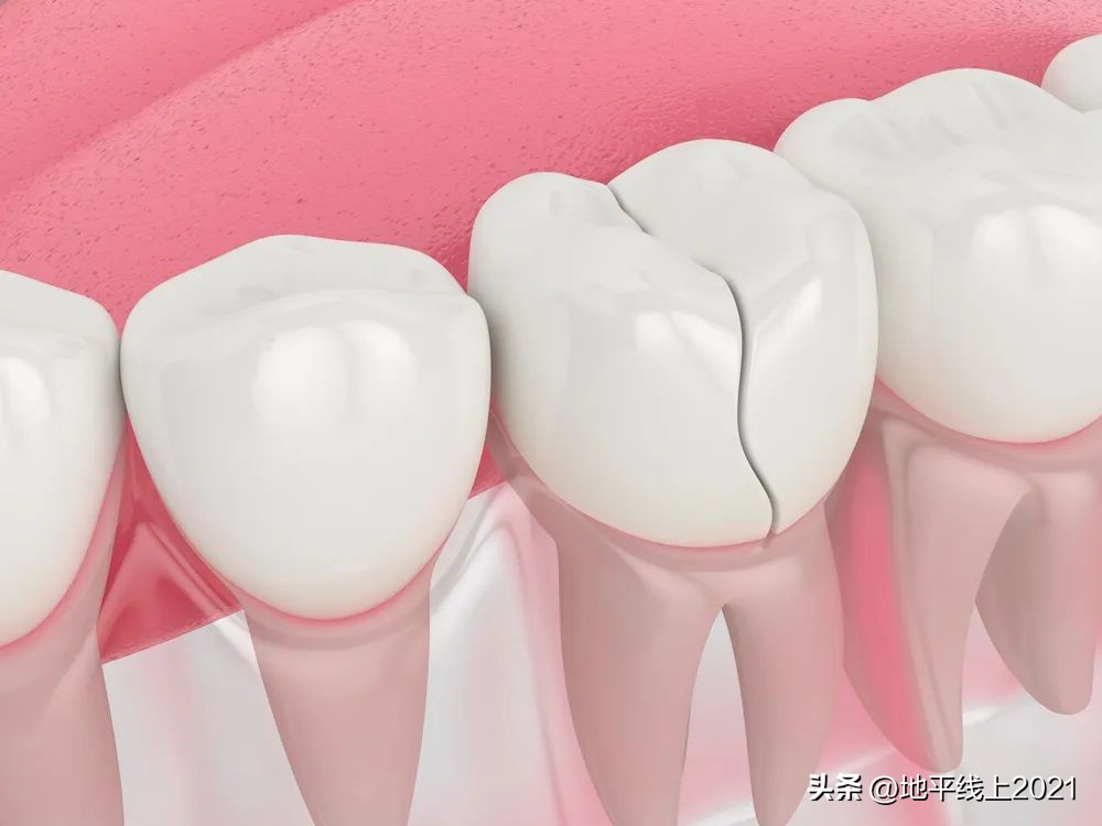 关于根管治疗的各种情况,根管治疗你不知道的秘密