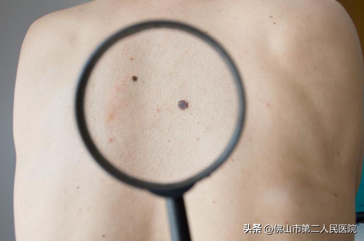 年轻歌手得黑色素瘤去世,歌手黑痣和黑色素瘤的区别