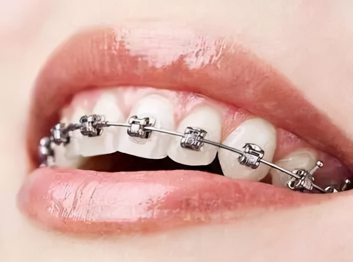 隐形牙套暴利,隐形牙套销售好做吗