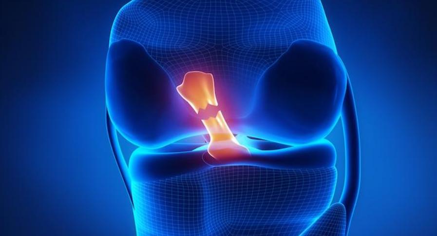 膝关节前交叉韧带损伤怎么治疗好,膝关节前交叉韧带损伤应该怎么办