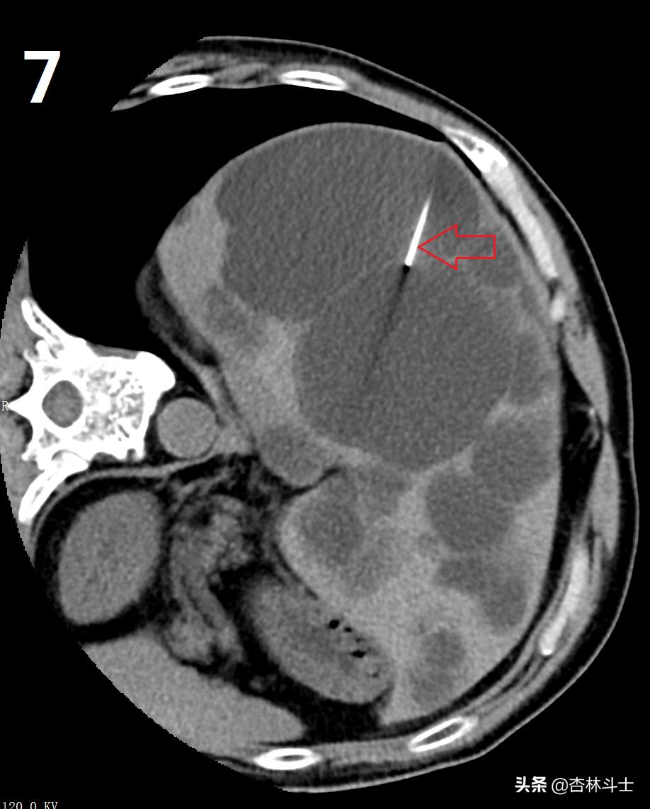 64岁银行职员患肝囊肿，CT引导下细针穿刺抽吸酒精硬化解决大问题