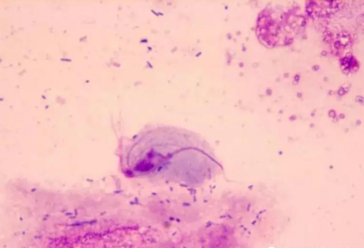 教你怎么辨别滴虫性、霉菌性、细菌性、萎缩性阴道炎