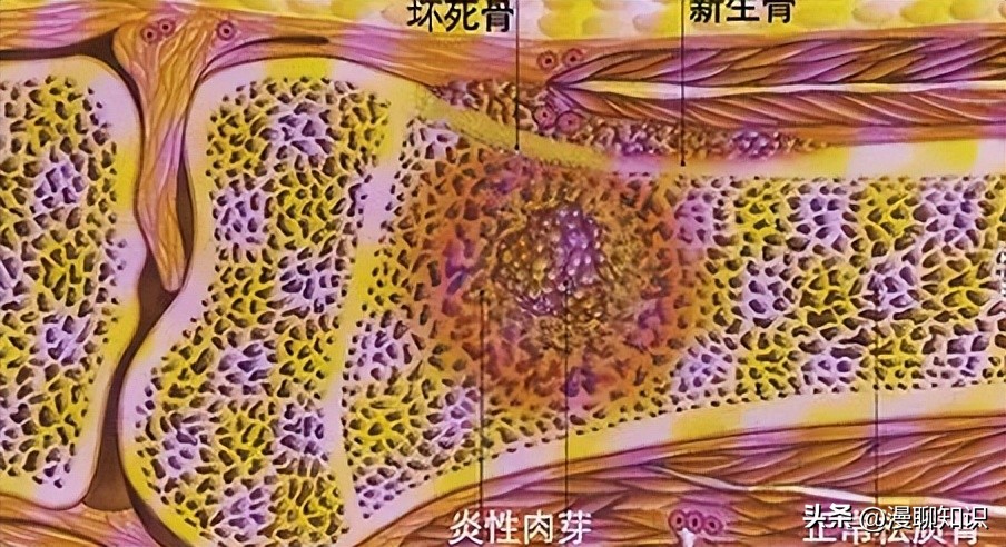 慢性复发性骨髓炎儿童案例,青少年得慢性骨髓炎能治好吗