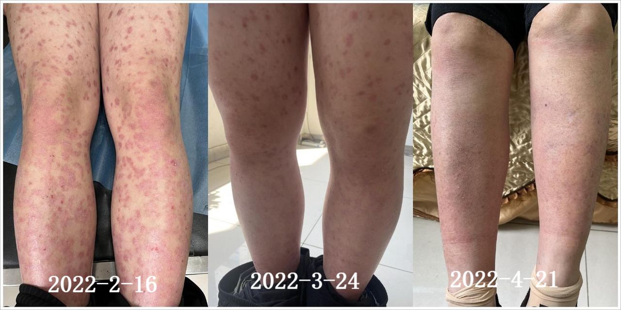 银屑病用生物制剂为什么要查乙肝,小三阳能打银屑病生物制剂吗