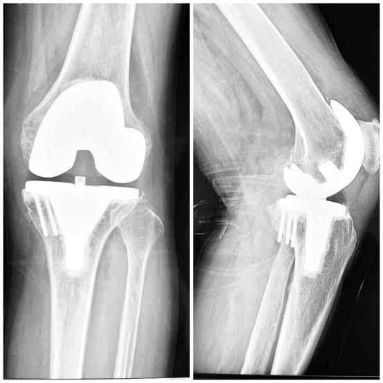 【学*党**史办实事】兰大二院西固医院骨科开展首例导航（IKPAS）下膝关节置换术（TKA）