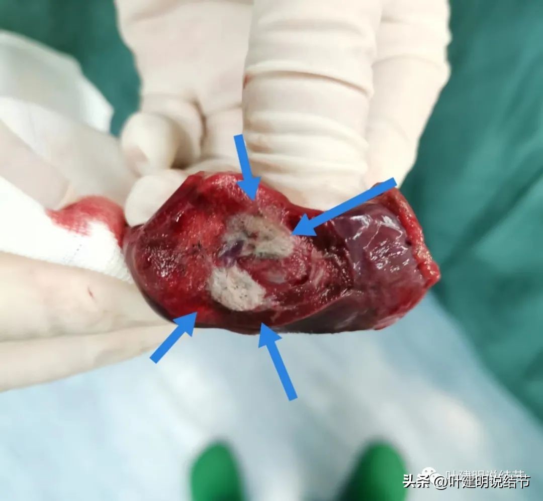 右下叶磨玻璃结节5*4,右下叶磨玻璃样结节多为炎性