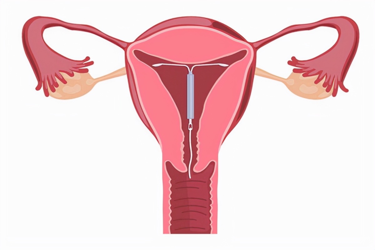 女性身体里的节育环,遗忘在妈妈体内的节育环