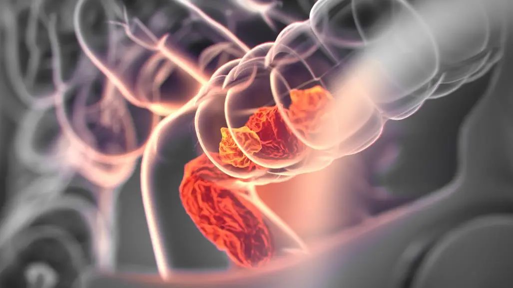 复旦肿瘤结肠癌,复旦大学肿瘤医院治结肠癌好吗
