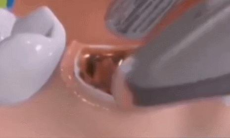 拔牙后牙窝里的海绵什么时候取出,一块海绵