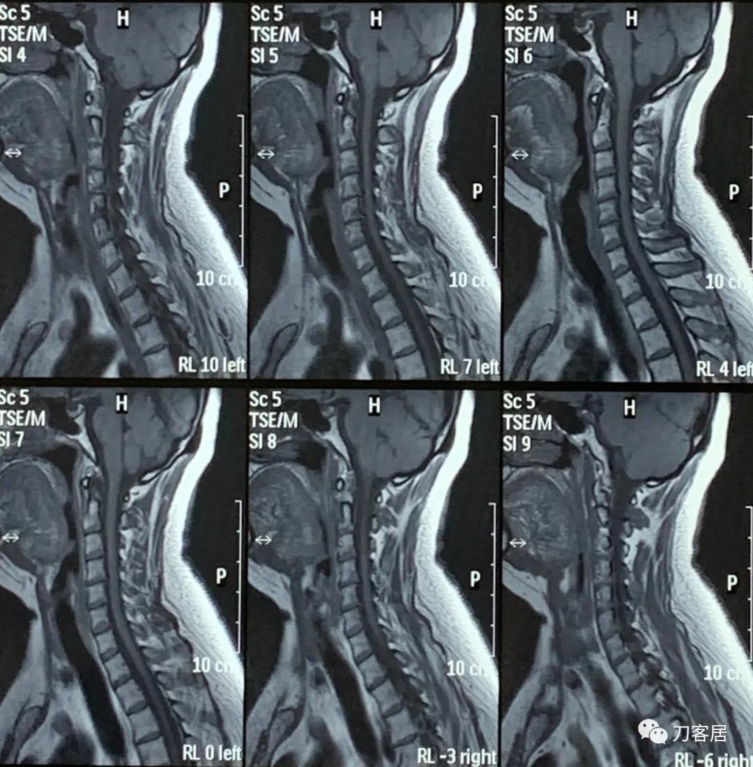 颈椎病十年了手臂酸痛肩背痛,颈椎病十年了一直痛怎么办