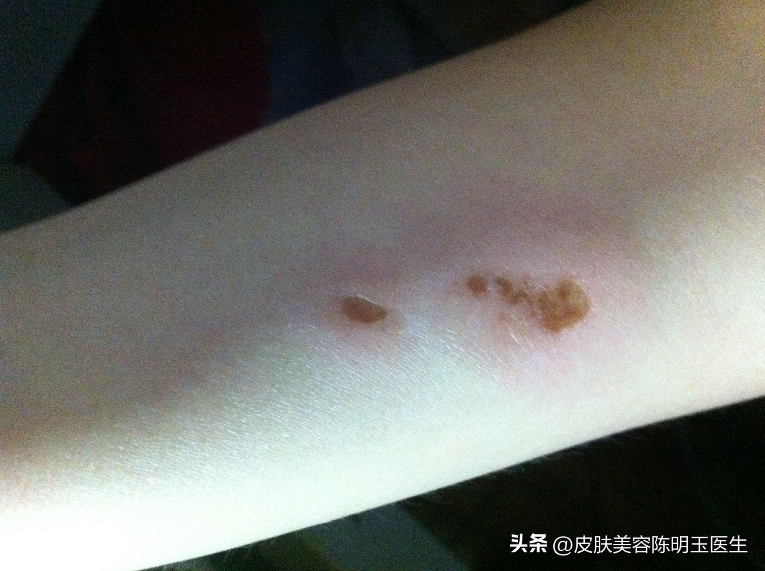 50岁男人脖子上长小肉粒怎么回事,脖子长了一些小肉粒是什么问题