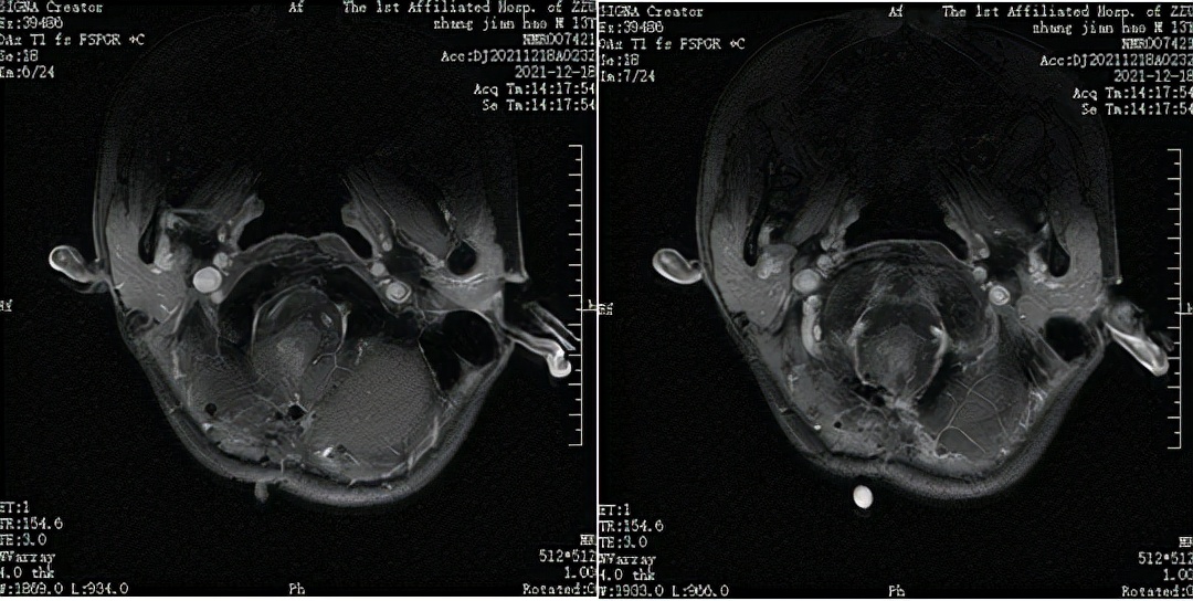听神经瘤郑大一附院,北京中医治疗脑干胶质瘤