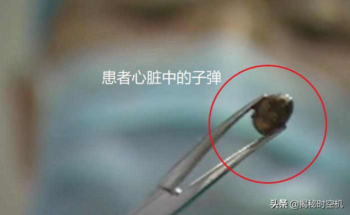 中国孤例！*弹子**击中心脏14年没死？湖南男子奇迹生还至今成谜