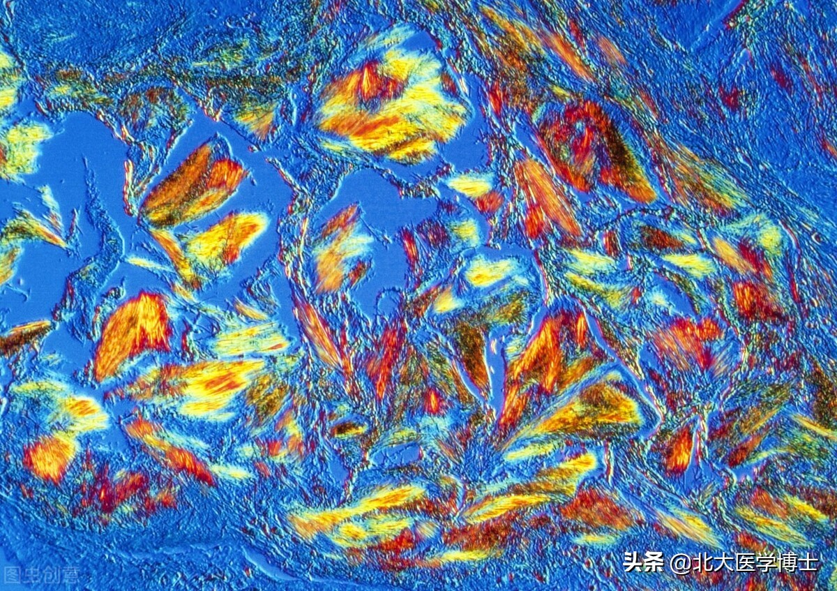 痛风发作尿酸高别急中医有妙招,痛风根治良方