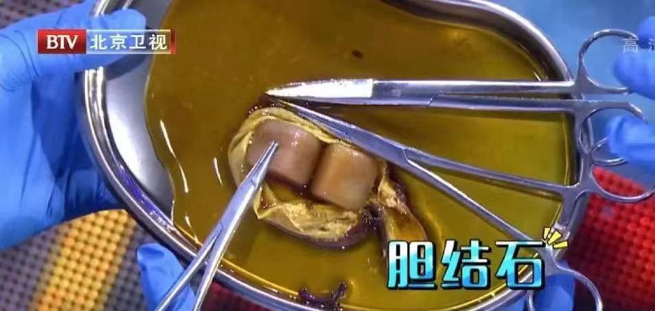 慢性肝损伤怎么引起消化系统疾病,疾病都是不良习惯造成的吗