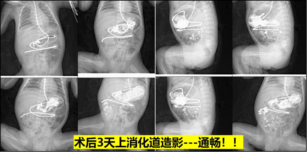 新生儿39天大口吐奶,35天的婴儿吐奶严重