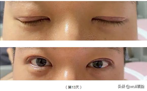 男生割双眼皮的意思,男生眼睛小割双眼皮会好看吗